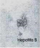 hepatitis